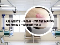 大腿内侧长了一块像癣一样的东西会传染吗 大腿内侧长了一块像癣用什么药