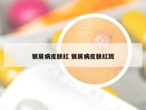 银屑病皮肤红 银屑病皮肤红斑