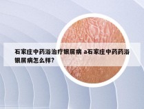 石家庄中药浴治疗银屑病 a石家庄中药药浴银屑病怎么样?