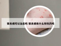 银肖病可以治愈吗 银肖病有什么特效药吗