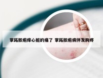 掌跖脓疱痒心脏的痛了 掌跖脓疱病伴发胸疼