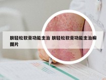 肤轻松软膏功能主治 肤轻松软膏功能主治癣图片