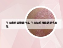 牛皮癣用硫磺跟什么 牛皮肤癣用硫磺肥皂有效