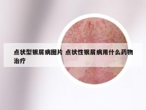 点状型银屑病图片 点状性银屑病用什么药物治疗