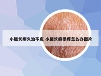 小腿长癣久治不愈 小腿长癣很痒怎么办图片