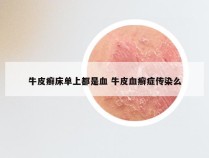 牛皮癣床单上都是血 牛皮血癣症传染么