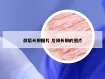 颈后长癣图片 后颈长癣的图片