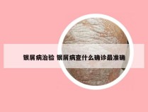 银屑病治验 银屑病查什么确诊最准确