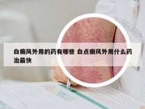 白癜风外用的药有哪些 白点癫风外用什么药治最快