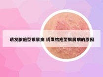 诱发脓疱型银屑病 诱发脓疱型银屑病的原因