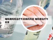 哺乳期妈妈治疗牛皮癣的药膏 哺乳期治疗牛皮屑