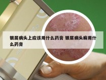 银屑病头上应该用什么药膏 银屑病头癣用什么药膏