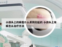 小孩头上的癣是什么原因引起的 小孩头上有癣怎么治疗方法