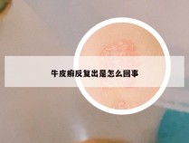 牛皮癣反复出是怎么回事