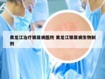 黑龙江治疗银屑病医院 黑龙江银屑病生物制剂