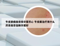 牛皮肤癣南京找华厦尽心 牛皮廨治疗用什么药膏南京信赖华厦好