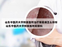 山东中医药大学附属医院治疗银屑病怎么样样 山东中医药大学附属医院皮肤科