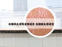 白癜风丸吉林省银诺克 白颠疯丸银诺克