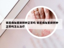 银屑病加重脚胖肿正常吗 银屑病加重脚胖肿正常吗怎么治疗