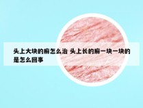 头上大块的癣怎么治 头上长的癣一块一块的是怎么回事