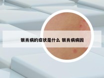 银肖病的症状是什么 银肖病病因