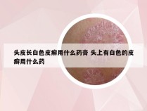 头皮长白色皮癣用什么药膏 头上有白色的皮癣用什么药