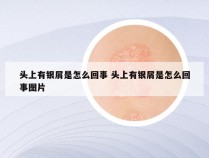 头上有银屑是怎么回事 头上有银屑是怎么回事图片