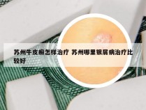 苏州牛皮癣怎样治疗 苏州哪里银屑病治疗比较好