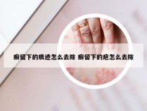 癣留下的痕迹怎么去除 癣留下的疤怎么去除