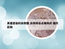 真菌感染的白斑图 白斑和白点癫风的 图片区别