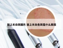 腿上长白斑图片 腿上长白色斑是什么原因