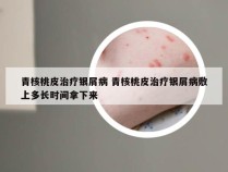 青核桃皮治疗银屑病 青核桃皮治疗银屑病敷上多长时间拿下来