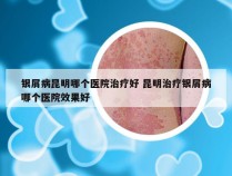 银屑病昆明哪个医院治疗好 昆明治疗银屑病哪个医院效果好