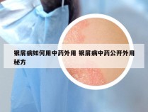 银屑病如何用中药外用 银屑病中药公开外用秘方