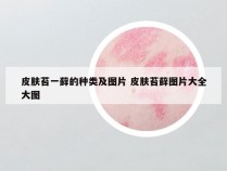 皮肤苔一藓的种类及图片 皮肤苔藓图片大全大图