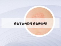 癣会不会传染吗 癣会传染吗?