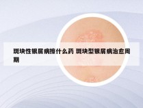 斑块性银屑病擦什么药 斑块型银屑病治愈周期