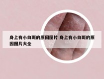 身上有小白斑的原因图片 身上有小白斑的原因图片大全