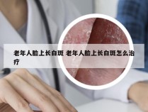 老年人脸上长白斑 老年人脸上长白斑怎么治疗