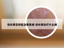 徐长卿怎样能治银屑病 徐长卿治疗什么病