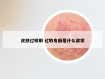 皮肤过敏癣 过敏皮癣是什么症状