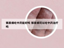 银屑病吃中药能好吗 银屑病可以吃中药治疗吗