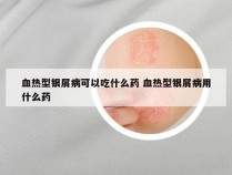 血热型银屑病可以吃什么药 血热型银屑病用什么药