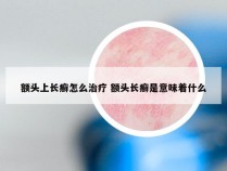 额头上长癣怎么治疗 额头长癣是意味着什么