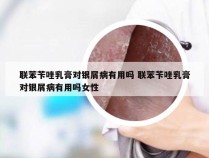 联苯苄唑乳膏对银屑病有用吗 联苯苄唑乳膏对银屑病有用吗女性