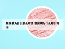 银屑病为什么那么可怕 银屑病为什么那么难治