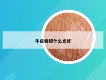 牛皮癣照什么光好