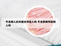 牛皮癣人的衣服会传染人吗 牛皮肤癣传染别人吗