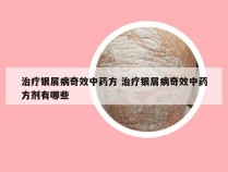 治疗银屑病奇效中药方 治疗银屑病奇效中药方剂有哪些