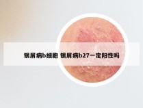 银屑病b细胞 银屑病b27一定阳性吗